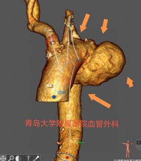 现实版“拆弹专家”！青大附院郭明金教授团队2小时微创“攻克”主动脉弓部动脉瘤-图1