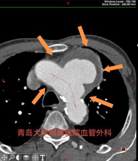 现实版“拆弹专家”！青大附院郭明金教授团队2小时微创“攻克”主动脉弓部动脉瘤-图2